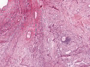 Grade 1: A single perivascular aggregate is shown in this image. No other field had more than this; many had less.