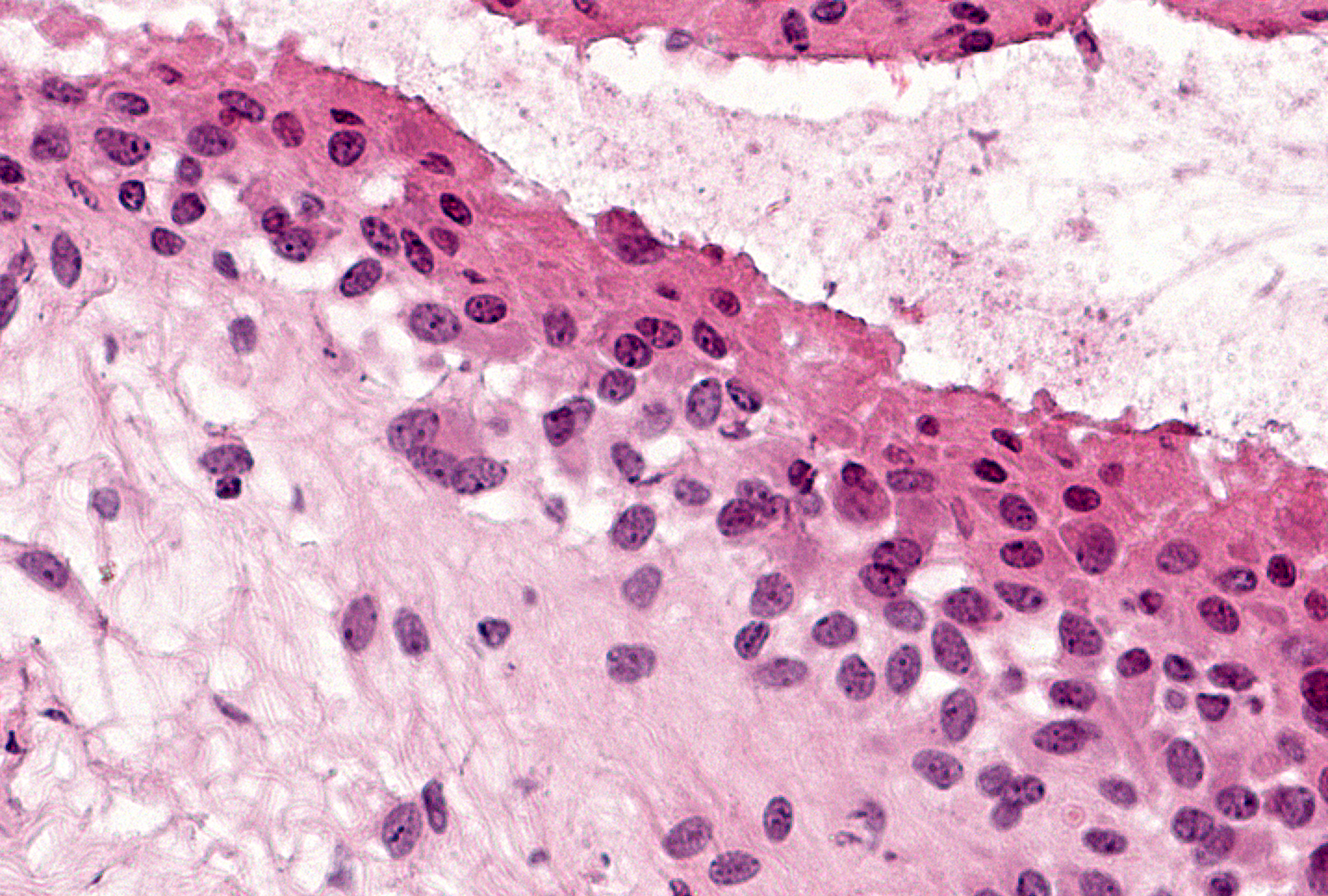 Grade 1 (present), Example 2: A small giant cell containing 3 nuclei is present at the base of this thickened lining layer.