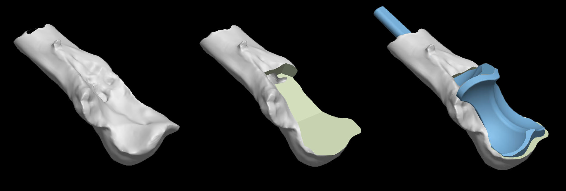 Pre-op 3D CT reconstruction