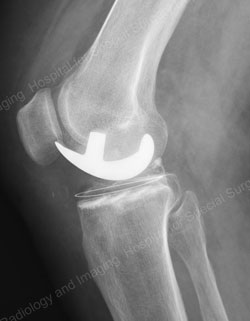 Radiograph example of a fixed bearing partial knee replacement