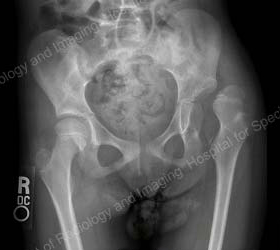 X-ray of a child with cerebral palsy showing dysplastic, dislocated left hip and abnormal alignment of the right hip.