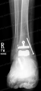 X-ray image of an arthritic ankle treated with a total ankle replacement