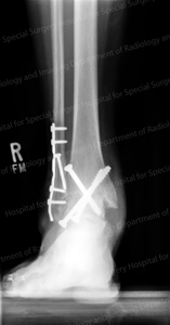 X-ray of an arthritic ankle after a fusion