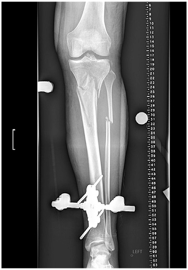 Managing high-energy, proximal tibia and fibula fracture | hss case