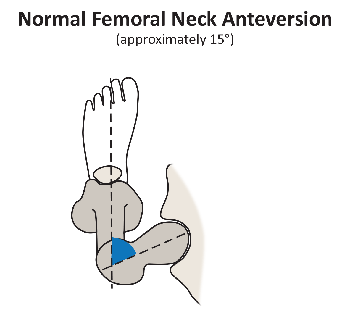 Illustration: Normal Femoral Neck Anteversion
