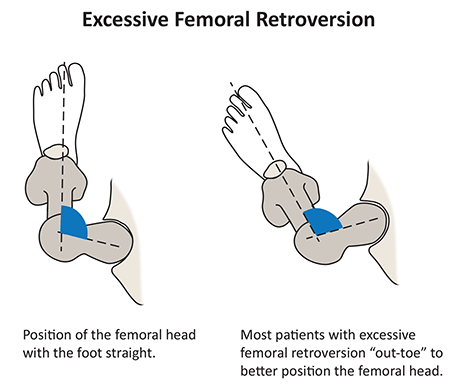 Illustration: Excessive Femoral Retroversion