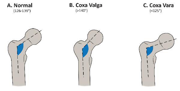 Illustration: femoral neck-shaft angle