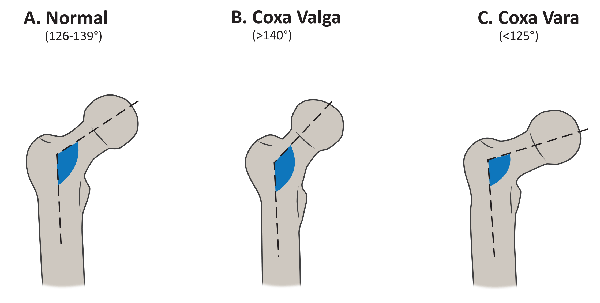 Fig3abc-Coxa-Valga_Vara.gif#s-600,303