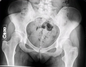 pelvis x-ray both hips