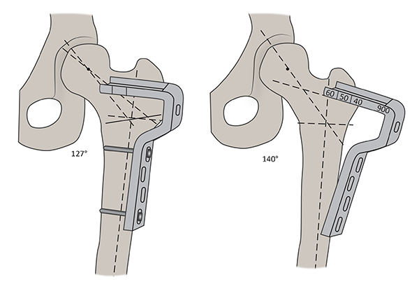 Illustration: vargus derotation osteotomy