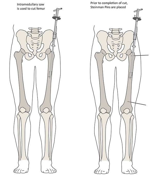Illustration: The technique of femoral derotation osteotomy, for the left leg 