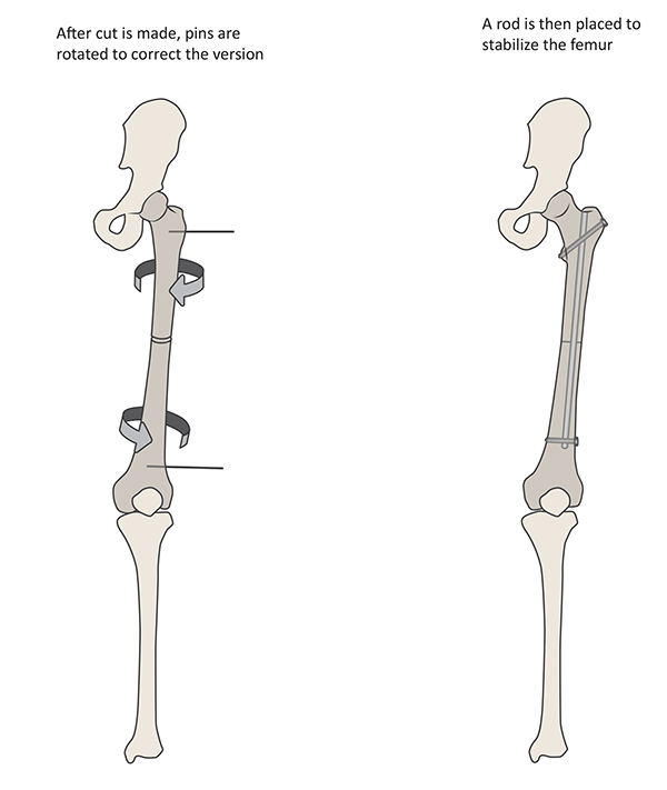 Illustration: After performing the osteotomy, the femur is rotated to achieve the desired correction.