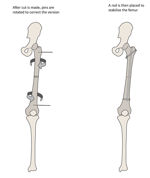 Fig7c-femur-rotation-osteotomy-stabilized-cd.gif