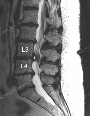 sagittale (zijaanzicht) MRI van een L3-4 hernia (gemarkeerd door *) die inslaat op de ruggenmergzenuwen.