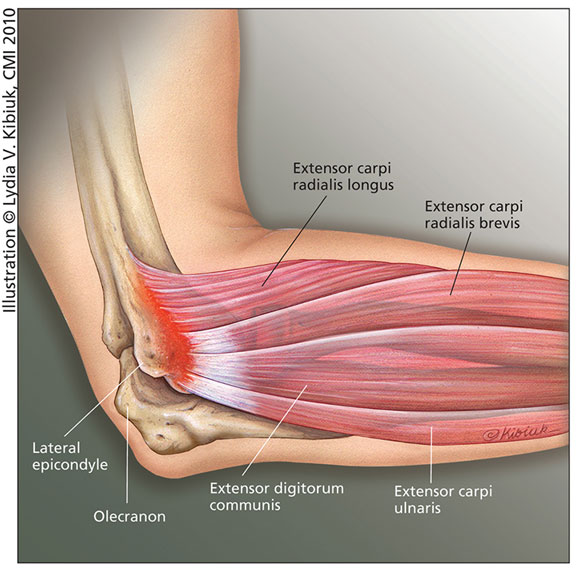 Illustration showing the origin of extensor muscles at the elbow