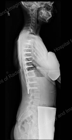 X-ray image showing (side view) posterior spinal fusion with instrumentation.