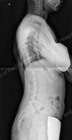 X-ray (side view) image showing a scoliosis curve.