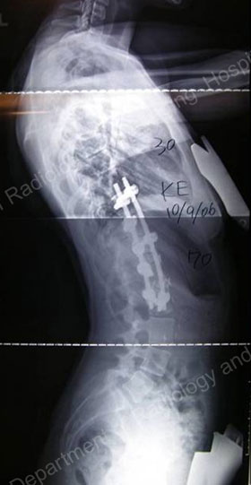 X-ray image showing a side view of a scoliosis requiring an anterior approach. 