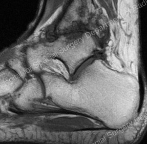 Image - loss of joint space