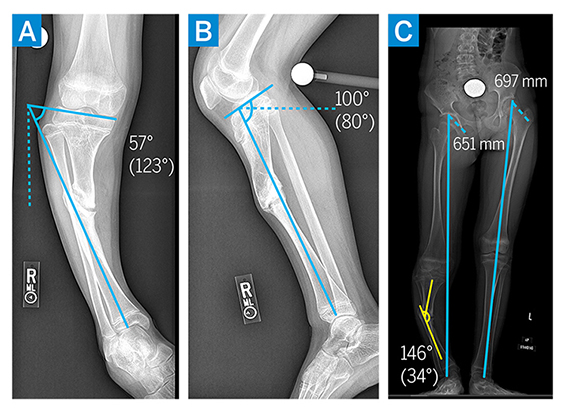 Tibia Lengthening and Deformity Correction With a Multiplanar External Fixator