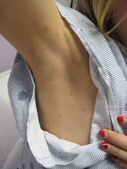 Photo showing axillary freckling under the armpits
