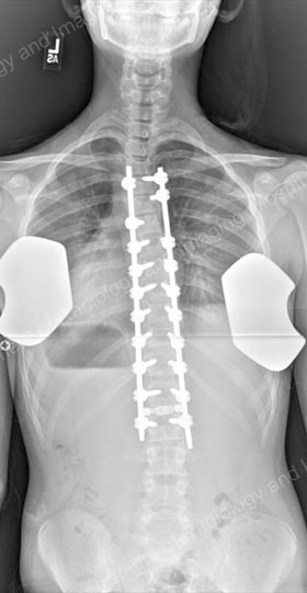 X-ray image showing (back to front) posterior spinal fusion with instrumentation.