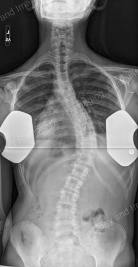 X-ray (front to back) image showing a scoliosis curve.