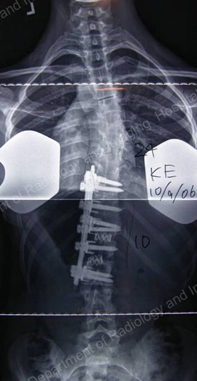 X-ray image showing a rear view of a scoliosis requiring an anterior approach. 