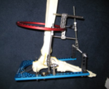 Image - an actual external fixator frame