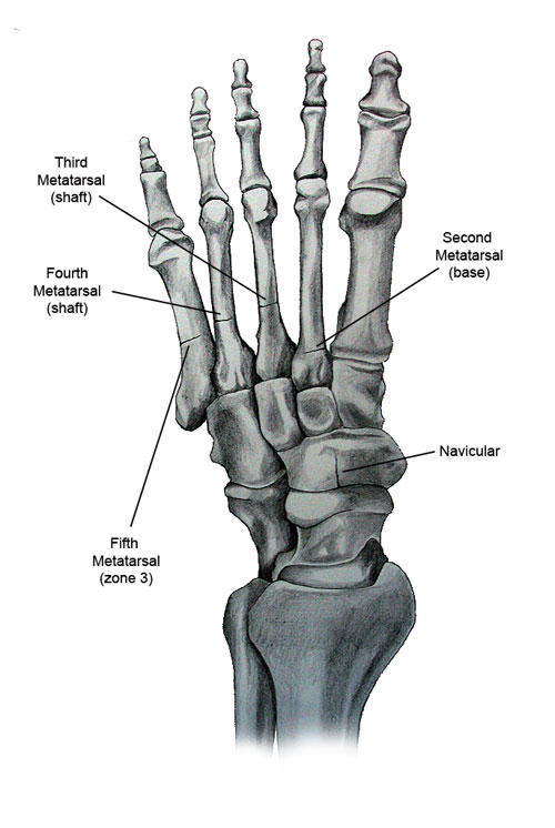 Anatomical drawing of the foot with labelling of the metatarsal and navicular bones.