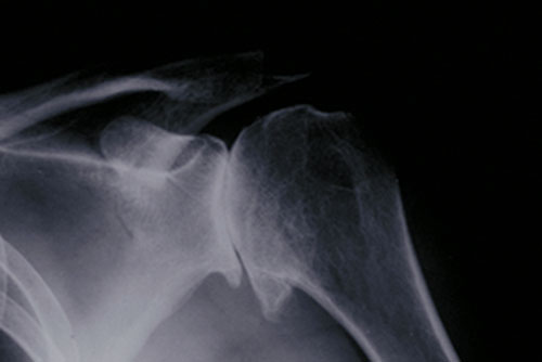 X-ray showing osteoarthritis of the shoulder joint