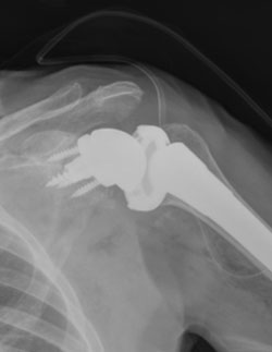 X-ray after reverse shoulder replacement.