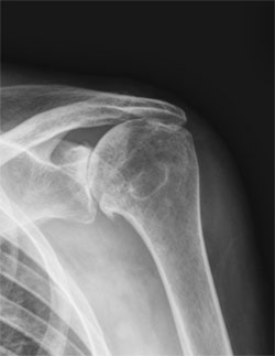 X-ray showing severe arthritis of the shoulder area with complete tear of the rotator cuff.