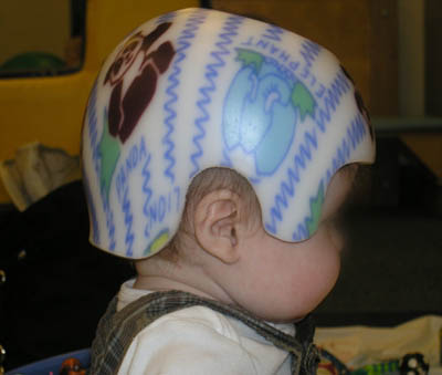torticollis helmet