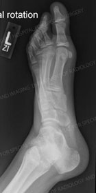 X-Ray image of the left foot with an Accessory navicular from an article about pediatric foot deformities