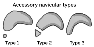 Illustration of types of accessory navicular.