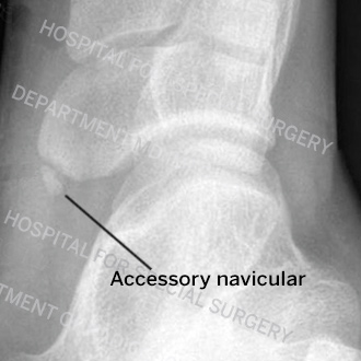 X-ray image of a type 1 accessory navicular.
