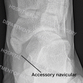 X-ray image of a type 2 accessory navicular.