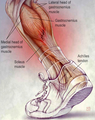 Illustration of the Achilles tendon and calf muscles.