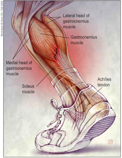 Labeled illustration of the anatomy of lower leg showing the gastrocnemius muscle, including the lateral and medial heads, the soleus muscle, and the Achilles tendon
