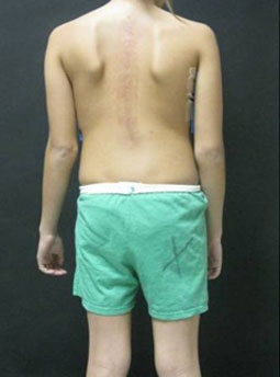 Photo of girl with adolescent idiopathic scoliosis in the thoracic spine, after surgery. 