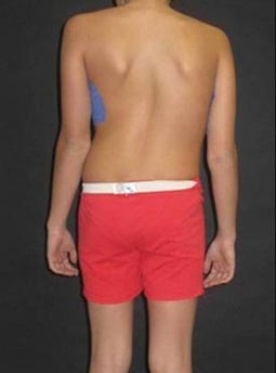 Photo of girl with adolescent idiopathic scoliosis in the thoracic spine, before surgery. 