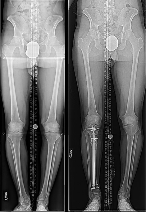 Before and after X-rays of a person with bowleg and rotational deformity having a tibial osteotomy with intramedullary nailing.