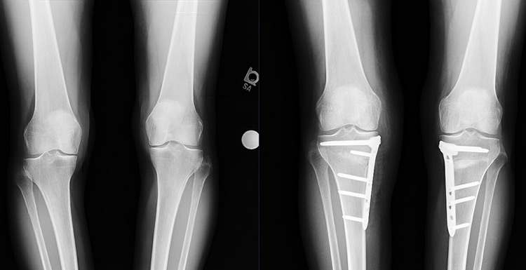 Before and after X-rays of tibial osteotomy surgery with internal fixation using plates and screws.