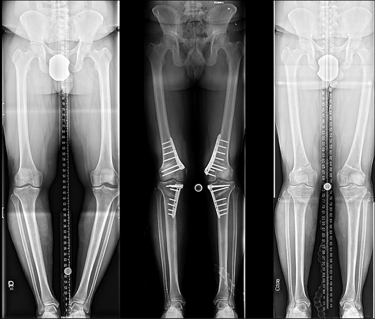Before and after X-rays of bowleg correction using a distal femoral osteotomy and tibial osteotomy with internal fixation.
