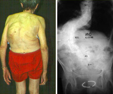 Image: Patient photo and X-ray of adult idiopathic scoliosis.