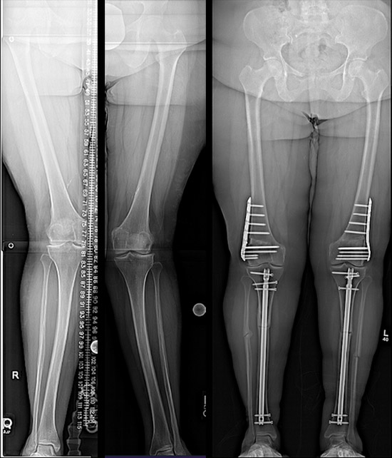 X-rays of knock knee corrected in tibia with an intramedullary nail and in femur with DFO using plates.