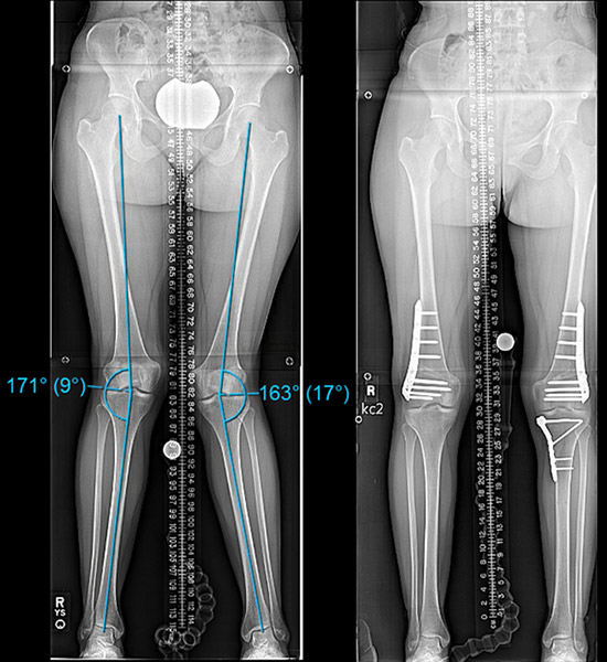 X-rays of knock knee correction using DFO and femoral osteotomy.