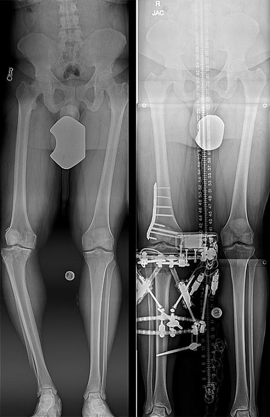 Before and after X-rays of a person with large bowleg deformity who had surgery with circular external fixation.