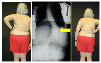 Image: Patient photo and X-ray showing adult scoliosis convexity of lumbar and thoracolumbar curves.